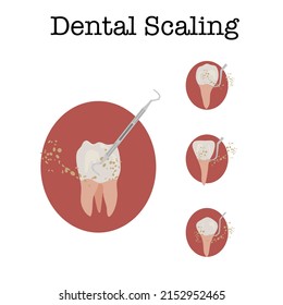 Dental Scaling set.Teeth 4 types with Dental Scaling text on top with circle background. Tooth scaling icon collection.Vector isolate flat design for Dental web or Clinic brochures  of Removal Tartar.