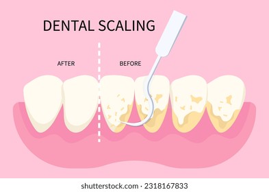 Procedimiento de escalado dental para limpiar el tartar de dientes y reducir el mal aliento para la higiene oral