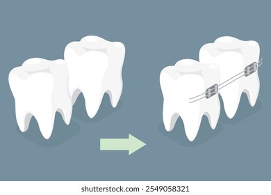 Zahnstomatologie Zahnspange auf Zähnen. Kieferorthopädisches Konzept. Isometrische Vektorgrafik