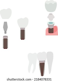 Dental surgery. Dental implants in flat design. Tooth implant screw in gum. Dental elements tooth, dental care and treatment illustration. Vector illustration.