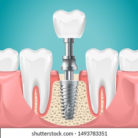 Dental surgery. Tooth implant cut vector illustration. Healthy teeth and dental implant, stomatology poster