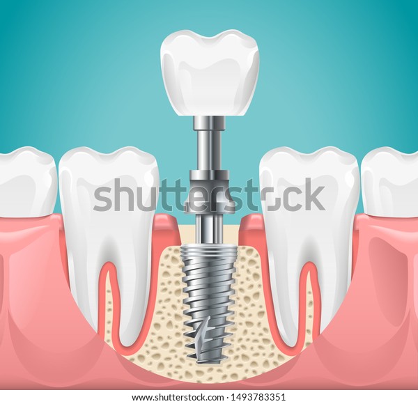 歯科手術 歯のインプラントの切り取りベクターイラスト 健康な歯 歯の移植 口腔科のポスター のベクター画像素材 ロイヤリティフリー
