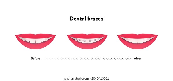 Dental teeth braces before and after infographic. Vector flat healthcare illustration set. Smile mouth with tooth and brace isolated on white background. Design for health care poster.