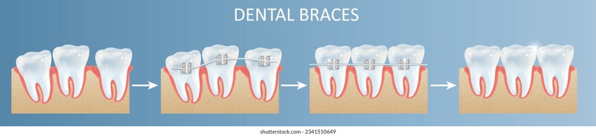 Dental teeth braces installation steps vector poster illustration. Dental medicine , stomatology and tooth treatment concept