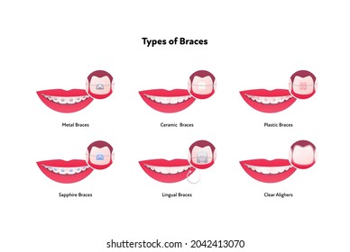 Dental teeth braces types infographic. Vector flat healthcare illustration set. Smile mouth with tooth. Different type of brace isolated on white background.