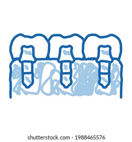 Implantes de dientes de dientes Implantes de boceto biomaterial vector. Dibujo de la línea de doodle azul dibujado a mano ilustración de símbolo aislado