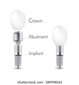 Dental tooth implant infographic vector illustration