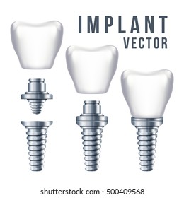 Dental tooth implant and parts vector illustration. Implantation dentistry and care to teeth