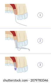 Dental treatment. Closed sinus lift. Dental services. Vector illustration for dental textbooks