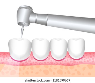 Dental treatment, dentistry. Dental instrument. Dental drill. The treatment of toothaches, drilling teeth. Vector illustration