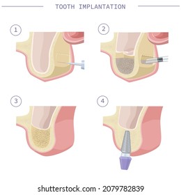 Dental treatment. Open sinus lift. Dental services. Vector illustration for dental textbooks. Step-by-step instruction