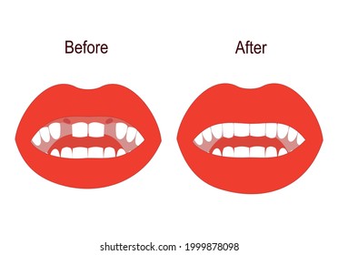 Dental treatment and prosthetics. Teeth before and after the doctor's treatment. The mouth is open. A visual vector illustration