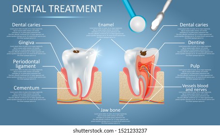 Dental treatment vector diagram, education poster template, medical anatomy infographics. Tooth structure and tooth decay caries disease development. Dentistry, dental restoration concept.