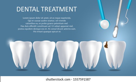 Dental treatment vector medical poster banner template. Realistic human teeth and dentist tools. Dental restoration or filling concept.