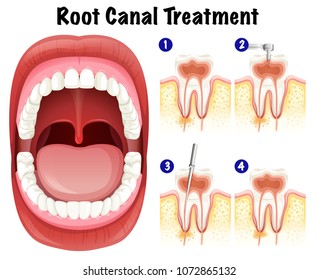Dental Vector of Root Canal Treatment illustration