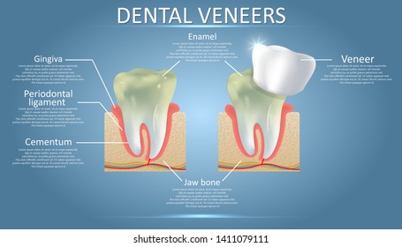 Dental veneers diagram, vector educational poster, medical infographic, presentation template. Dental restoration concept.