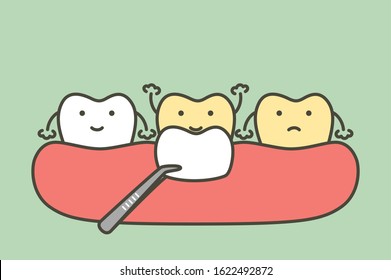 dental veneers installation procedure for tooth whiten - teeth cartoon vector flat style cute character for design