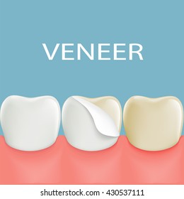 Dental veneers on a human tooth. Stock vector illustration.