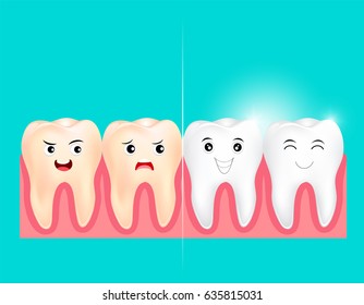 Dental veneers on a human tooth.  Before and After, whitening oral care concept. Deep cleaning, clearing tooth process.  illustration on green background.