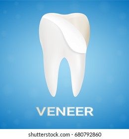 Dental Veneers On A Human Tooth Isolated On A Background. Realistic Vector Illustration. Healthcare stomatology and cleaning professional teeth illustration