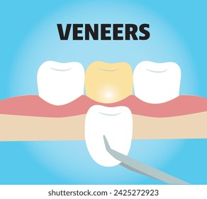 Dental veneers on teeth. Teeth and smile makeover 