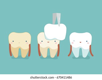 Dental Veneers ,teeth and tooth concept of dental