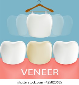 Dental veneers. Tooth anatomy. Stock vector illustration.