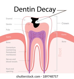 Dentin Decay.