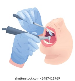 Las manos del dentista perforan los dientes. Cirugía dental, manos estomatólogas en guantes estériles con herramienta médica de limpieza paciente boca abierta, odontología tratamiento dental Ilustración vectorial elegante