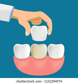 Dentist installation porcelain dental veneers. Stock vector illustration.