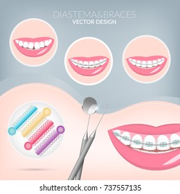 Dentist, orthodontist. Teeth healthy and dental braces. Dentistry instruments metal braces, Dental Ligature Ties, aligners. Vector illustration  