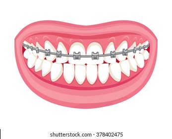 Dentist, orthodontist. Vector illustration. Braces on teeth. open mouth. White background.