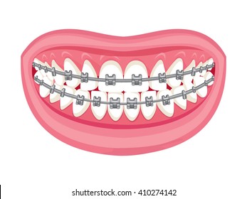 Dentist, orthodontist. Vector illustration. Braces on teeth. open mouth. White background.