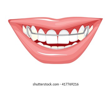 Dentist, orthodontist. Vector illustration. Braces on teeth. open mouth. White background.