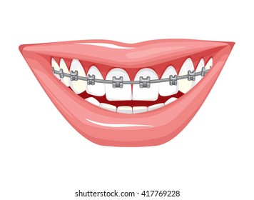 Dentist, orthodontist. Vector illustration. Braces on teeth. open mouth. White background.