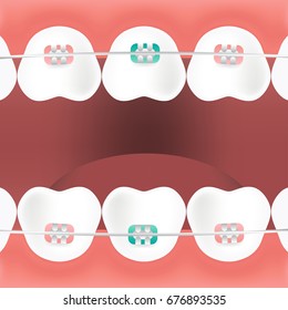 Dentist, orthodontist. Vector illustration. Braces on teeth. open mouth. White background.