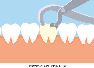 Dentist pulling out a dead tooth with equipment. Dental care activities with a dentist nipper and a dead tooth vector. Dead tooth extraction Illustration. Teeth removal concept.