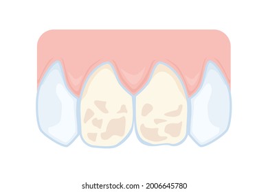 Odontología: Esmalte dañado de los dientes delanteros. Problemas dentales. Ilustración vectorial para materiales didácticos sobre odontología.