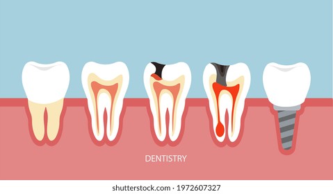 Dentistry for dental disease. Implantation. Illustration in flat style.
