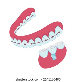 Dentistry isometric icon with dental implant and braces on teeth 3d isolated vector illustration