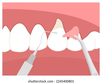 Dental Scaling el procedimiento para eliminar bacterias en placa del diente