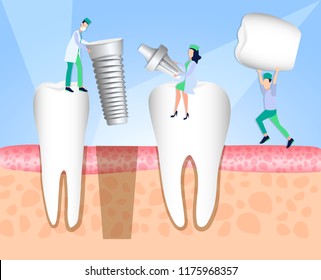 Dentists install a dental implant. Dentistry. Implantation and treatment of human teeth. Vector illustration