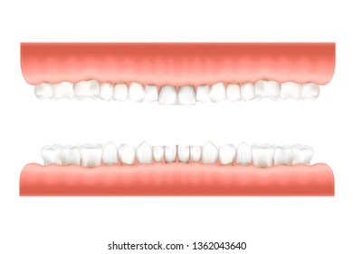 Dentition infographic chart with realistic human teeth in pink gum on upper and lower jaws on white