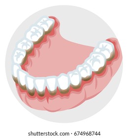 Dentition of the lower jaw - Periodontal disease