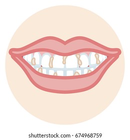 Dentition - Plaque