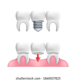 Denture concept - healthy teeth with fixed dental bridgework and implants. Vector illustration of human teeth in a 3d realistic style isolated on a white background