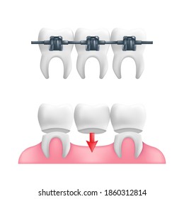 Denture concept - healthy teeth with a fixed dental bridgework and braces on top of them. Vector illustration of human teeth in a 3d realistic style isolated on a white background