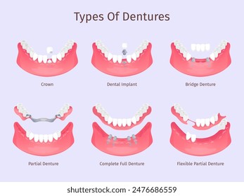 Dentures types. Tooth biting restorations dental care prosthesis teeth implant partial bridge complete full removable denture plastic crown, dentistry swanky vector illustration