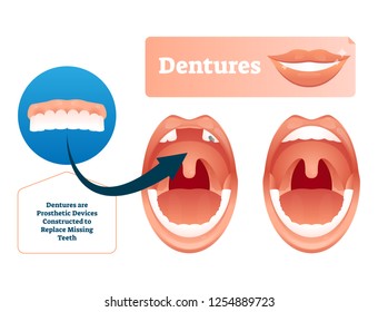 Dentures vector illustration. Medical prosthetic device for missing teeth. Human example with before and after tooth replacement technology concept. Closeup with oral mouth problem and extracted tooth