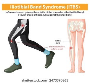 Depicts knee inflammation and pain from ITBS